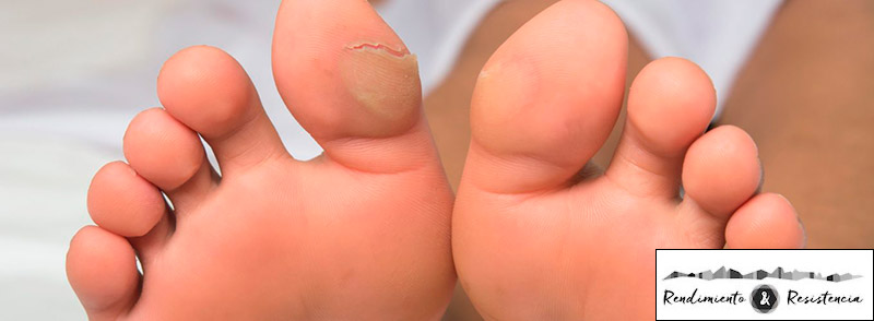 Ampollas en los dedos de los pies